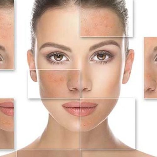 pigmentation removal southampton