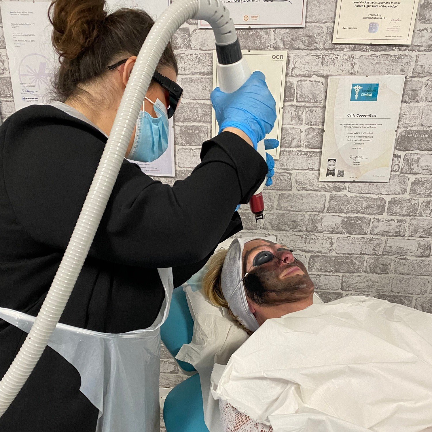 Carbon Laser Peel Facial