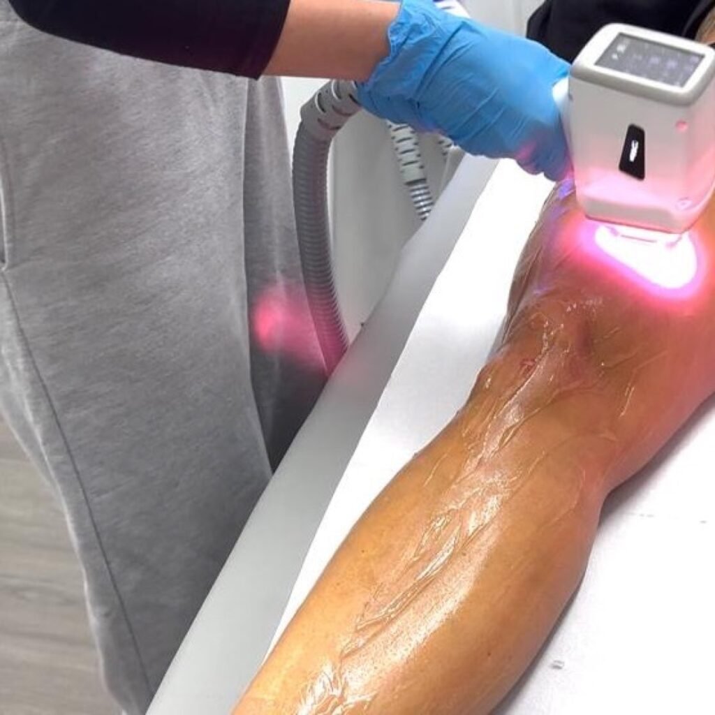 Light and laser hair removal: a gloved practitioner treats a client leg with a handpiece glowing pink over a layer of gel