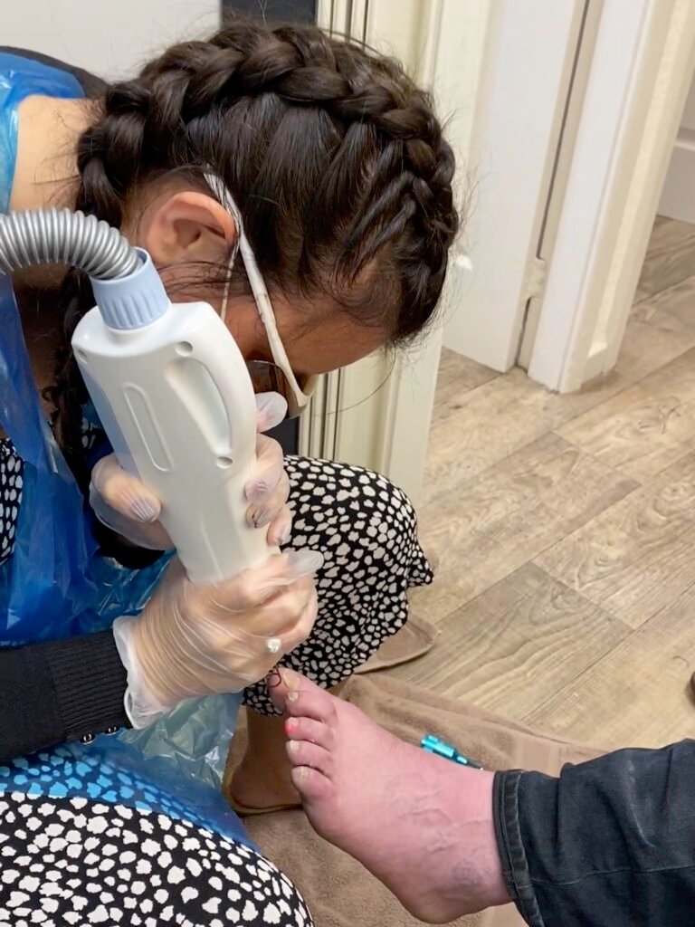 Laser nail fungus treatment: a practitioner in laser safety eyewear, gloves and apron treats a toenail