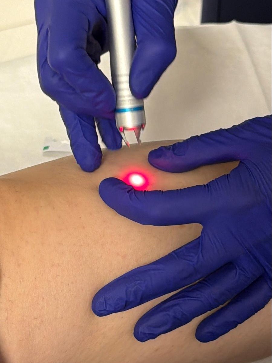 Laser and Light Vascular Therapy